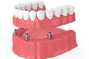 implant-retained denture on bottom arch 