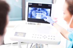 Emergency dentist in San Antonio showing patient X-ray