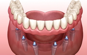 A digital image of a set of implant dentures in San Antonio