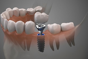 Model of abutment being attached to an implant