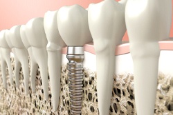 A diagram of an integrated dental implant.