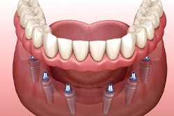 An implant-retained denture.