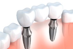 A diagram of an implant-retained bridge.