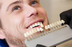 Man’s smile compared with tooth color chart