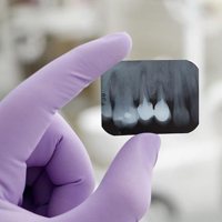 Dental X-Ray