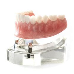  implant-retained dentures
