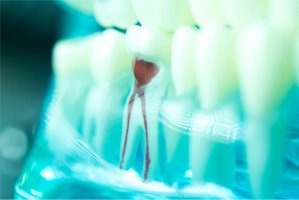 A broken tooth highlighting the cost of a root canal in San Antonio