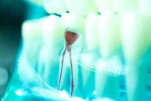 an illustration of the root canal process in San Antonio