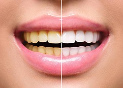 before and after teeth whitening