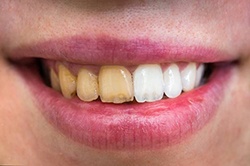 teeth whitening family