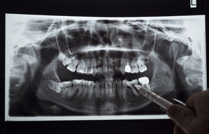 x-ray of teeth