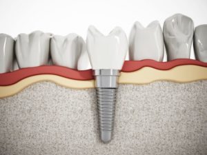 dental implants diagram