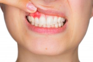 woman showing pink spot on gums