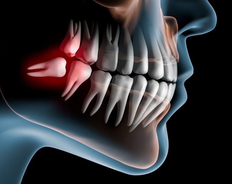 impacted wisdom tooth